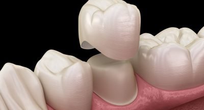 5-essential-tips-for-caring-for-your-ceramic-crown