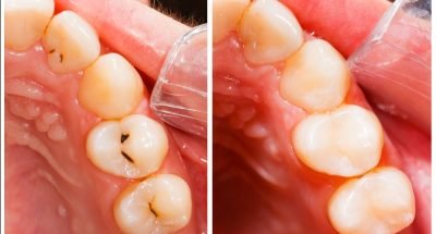 Composite-Tooth-Colored-Fillings.jpg.optimal