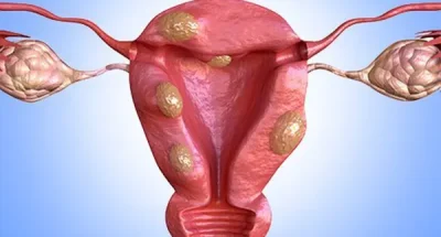 Myomectomy