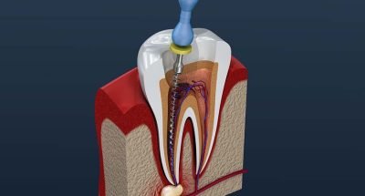 Root canal treatment process. 3D illustration