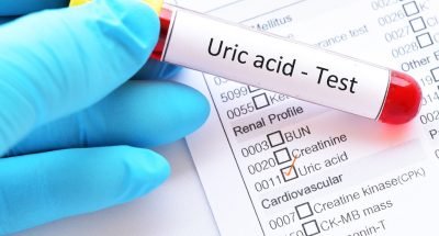 Uric_Acid_AdobeStock_210541980-min