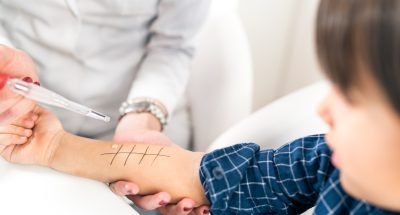 Skin Prick Allergy Testing for Children