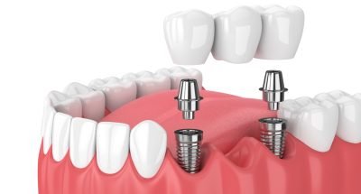 implantdisnedir