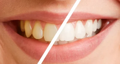 teeth-whitening-difference