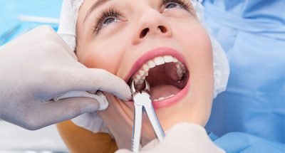 tooth-extraction-at-Good-Samaritan-Dental-Implant-Institute